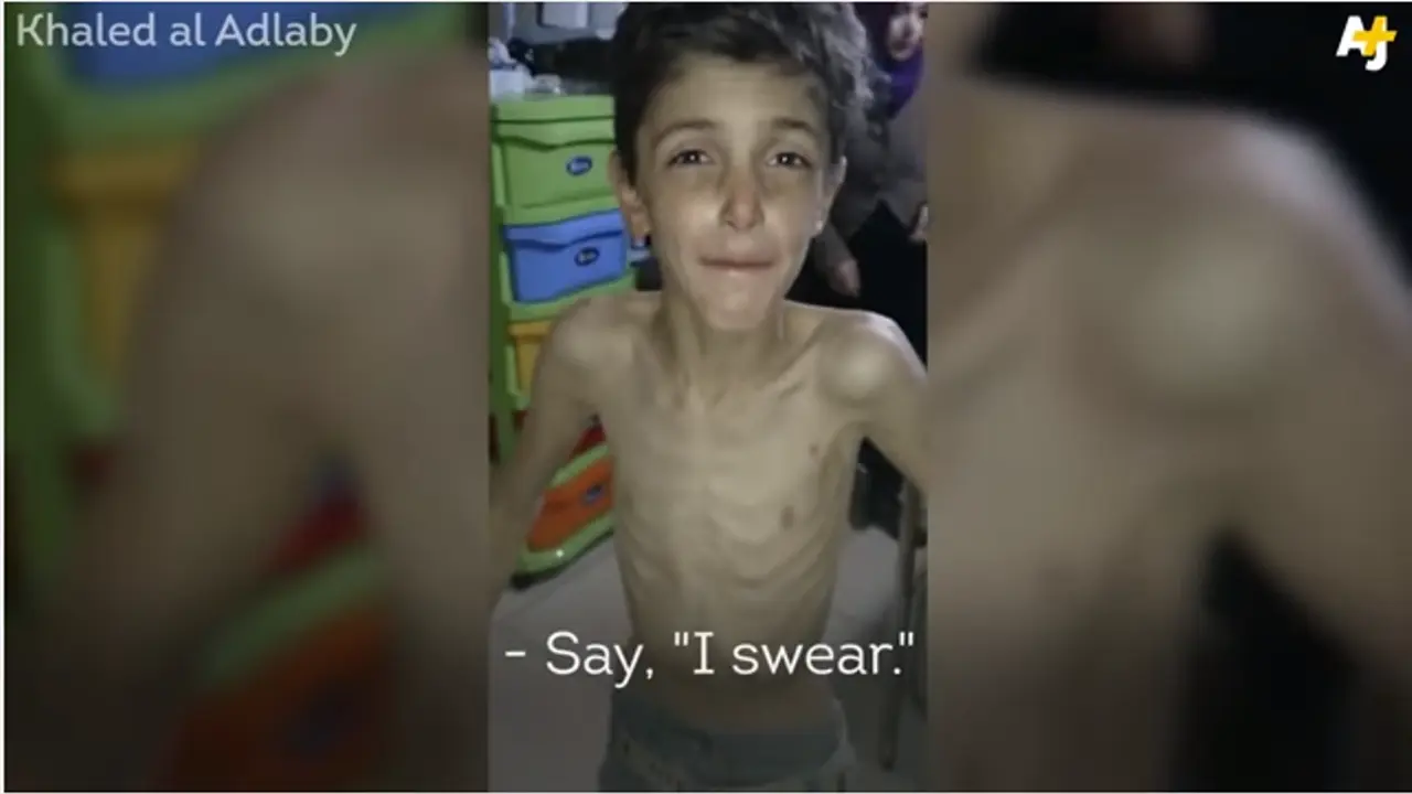 Tanpa Makanan, Anak-anak Suriah Tinggal Tulang Berbalut Kulit