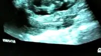 Seorang ibu mendapatkan kejutan menyenangkan melihat gerak-gerik bayinya di dalam rahim.