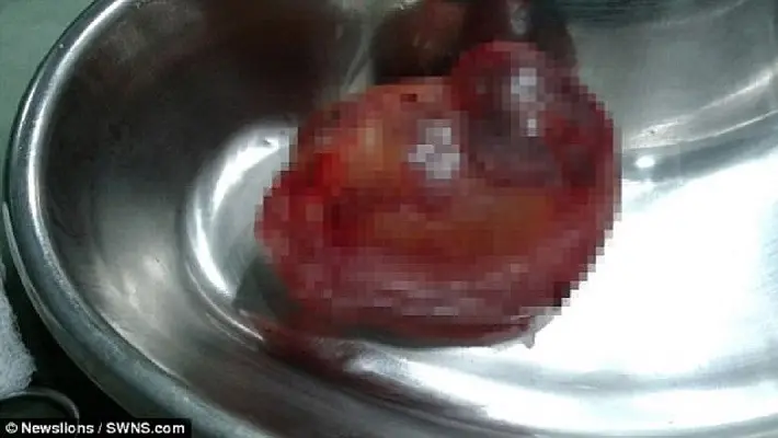 Bayi parasit di temukan di dalam perut Bayi kembarnya (SWNS.com)