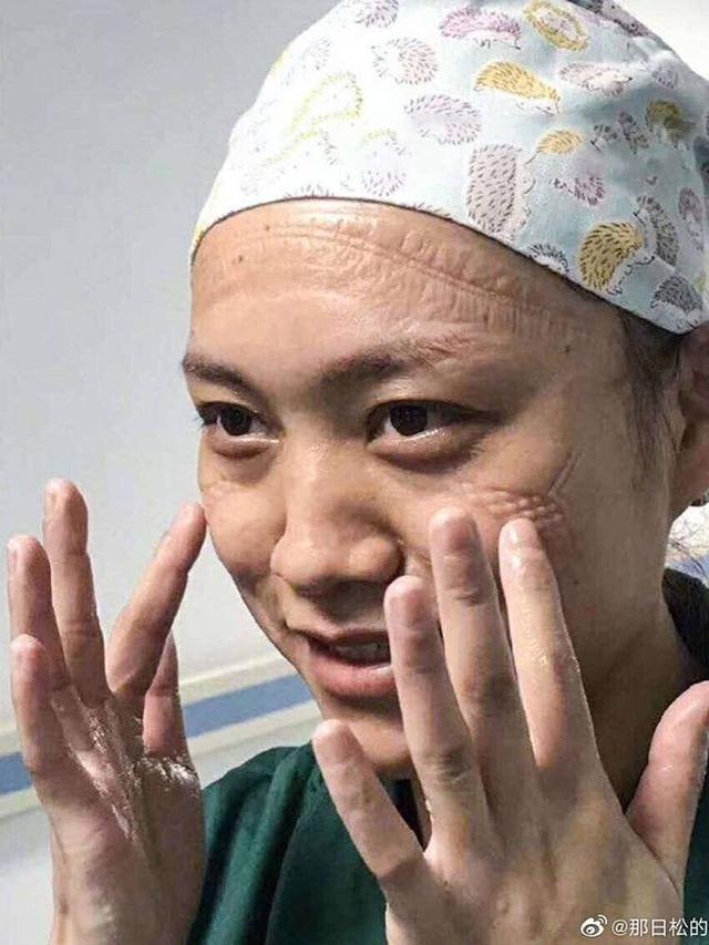 7 Potret Luka Lebam di Wajah Tim Medis Akibat Kacamata Pelindung Selama Perangi Virus Corona