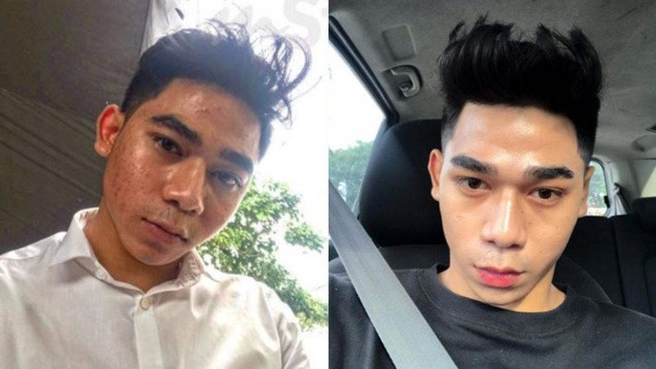 Dulu Dibully Wajah Seperti Jalanan Rusak, Perubahan Pria Ini Bikin Kagum