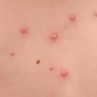 Cara Ampuh dan Efektif Hilangkan Bekas Luka Cacar Air