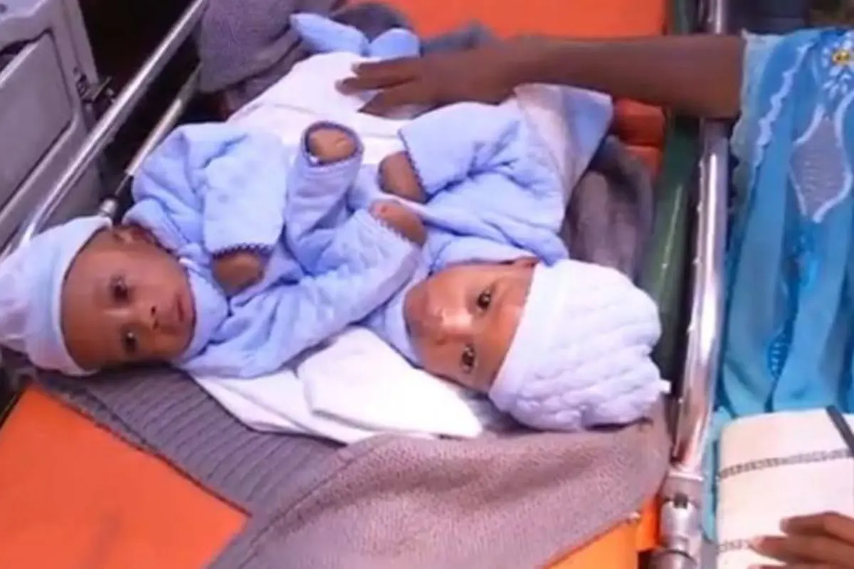 bayi kembar siam