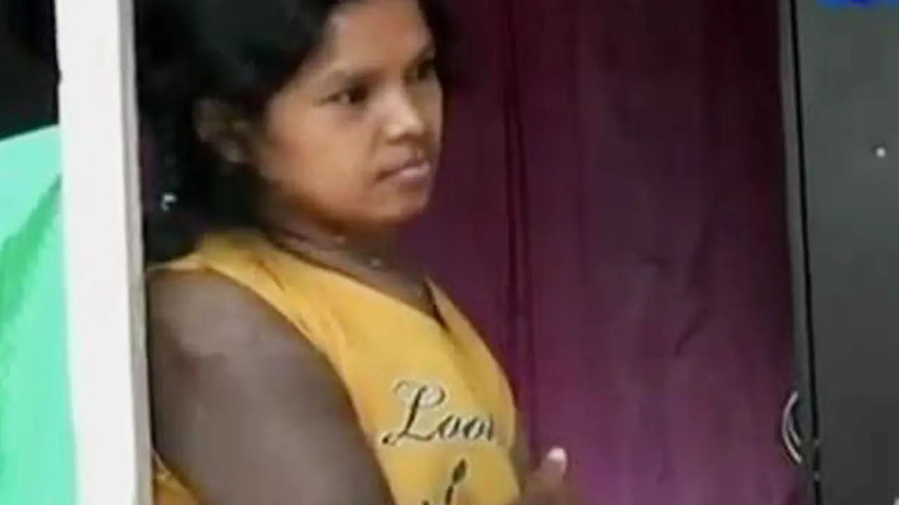 Juwita, Si Manusia Karet Berobat Ditolak 2 Rumah Sakit
