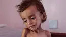 Seorang anak laki-laki penderita gizi buruk berada di tempat tidur rumah sakit di Aslam Health Centre, Hajjah, Yaman (1/11). Pertempuran di kota pelabuhan Hodeida mengancam terhentinya bantuan kemanusiaan. (AP Photo / Hani Mohammed)