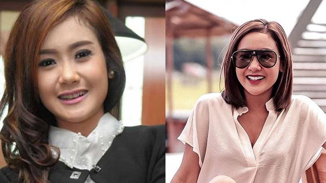 6 Transformasi Seleb Setelah Perbaikan Gigi, Terbaru Elly Sugigi