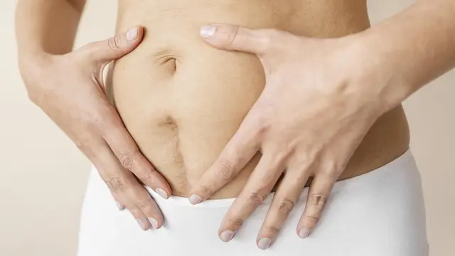 Apa Itu Stretch Mark?