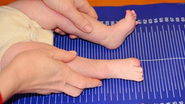 Kenali Apa Itu dwarfisme dan Penyebabnya