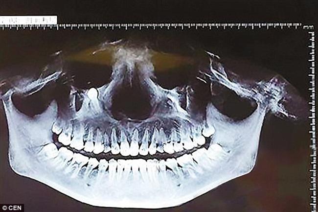 Hasil ronsen gigi Cao Fang yang tumbuh di bawah mata | Photo: Copyright asiantown.net