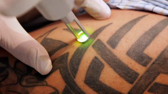 17 Kecanggihan Laser Penghapus Tato Wajib Kamu Lihat Sebelum Mati