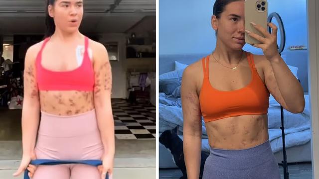 Tubuh Influencer Berakhir Digerogoti Penyakit Karena Suntikan Pembakar Lemak