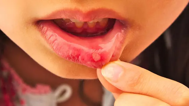 9 Penyebab Sariawan pada Anak