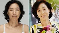 Wajah-wajah Permak Orang Korea, Sebelum dan Sesudah Operasi (4)