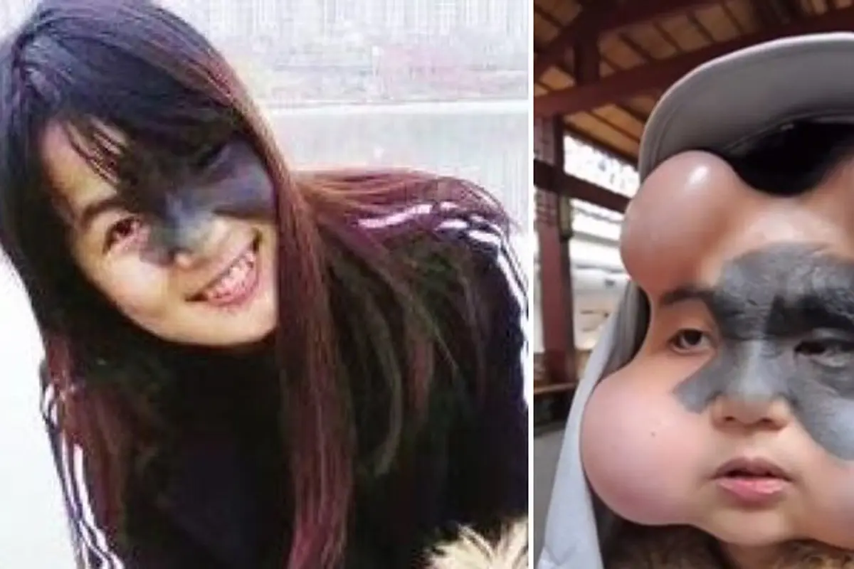 Kanker Tahi Lalat, Wajah Gadis Ini Berubah Mirip Boneka Anime