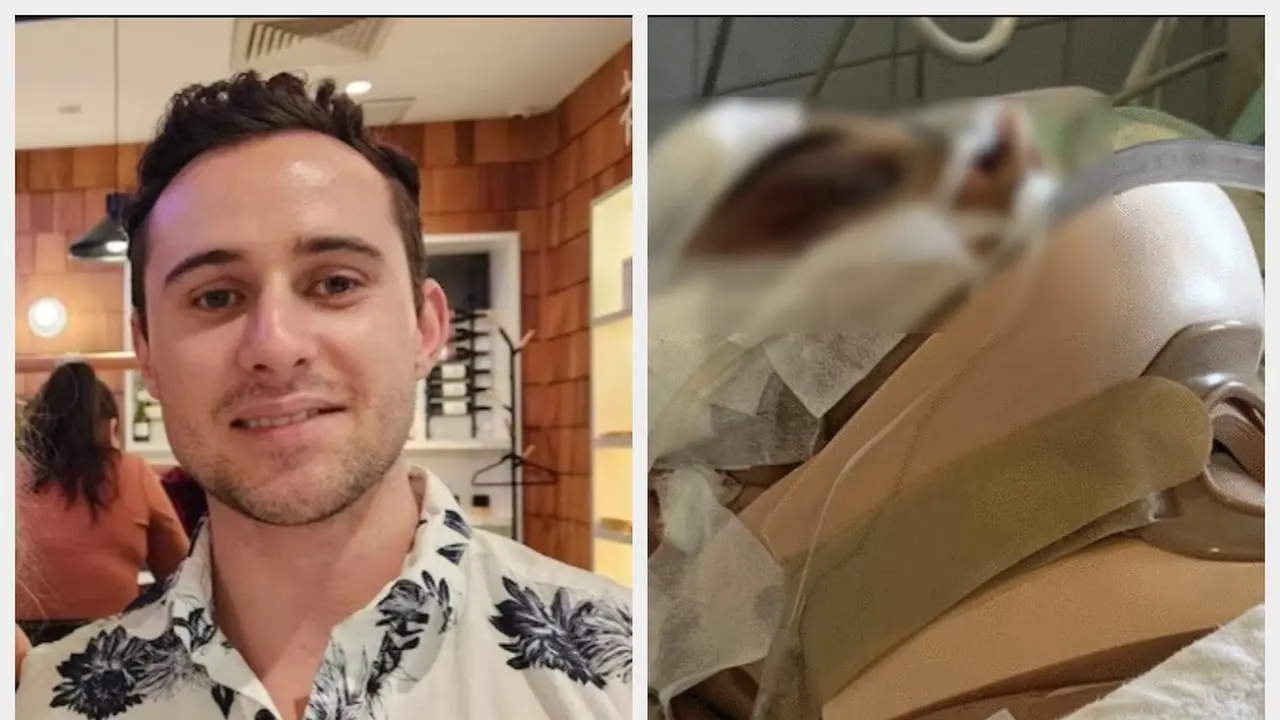 Blake Gibb, bule dari Australia yang mengalami kecelakaan motor di Pulau Lembongan, Bali.