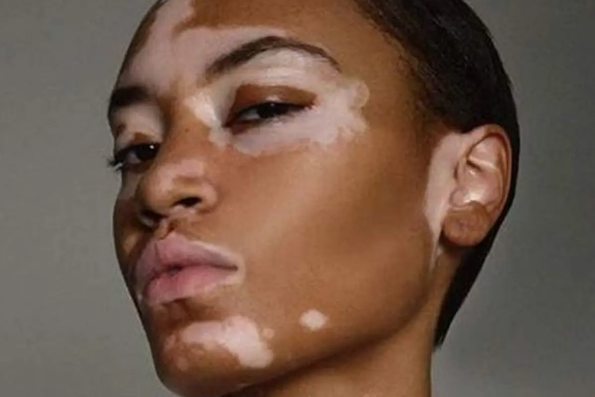 [Bintang] Menderita Vitiligo, Amy Deanna Berhasil Jadi Model yang Mendunia
