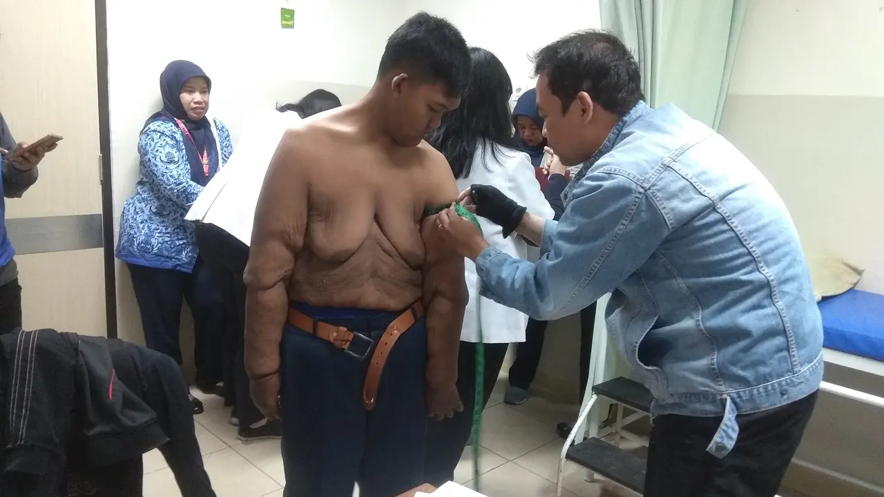 Pasien yang dulu obesitas Arya Permana asal Karawang bakal menjalani operasi bedah plastik untuk mengurangi kulit menggelambir di beberapa bagian tubuhnya. (Foto: Liputan6.com/Arie Nugraha)