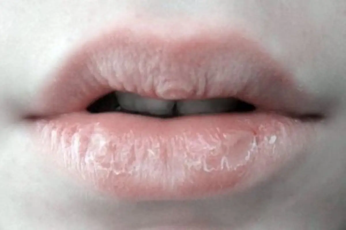 Bibir kering