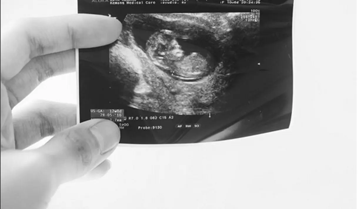 Wanita berusia 25 tahun itu mengunggah foto hasil Ultrasonografi (USG) janin yang tengah dikandungnya. (Via Instagram/@ayudiac)