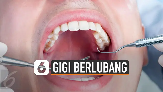 Gigi berlubang bisa terjadi akibat kebiasaan buruk seperti konsumsi makanan manis yang mengandung gula.