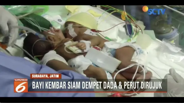 RSUD Dokter Soetomo Surbaya, kembali menangani bayi kembar siam dempet perut dan dada, setelah mendapati rujukan dari Rumah Sakit Ibu dan Anak Fatimah Lamongan.