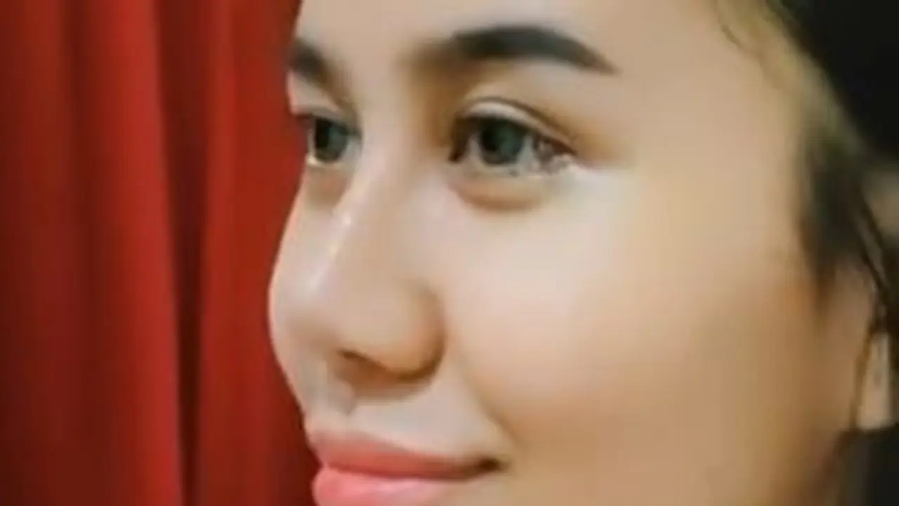 Potret Mayang Lucyana Lepas Perban Usai Operasi Plastik di Bagian Hidung