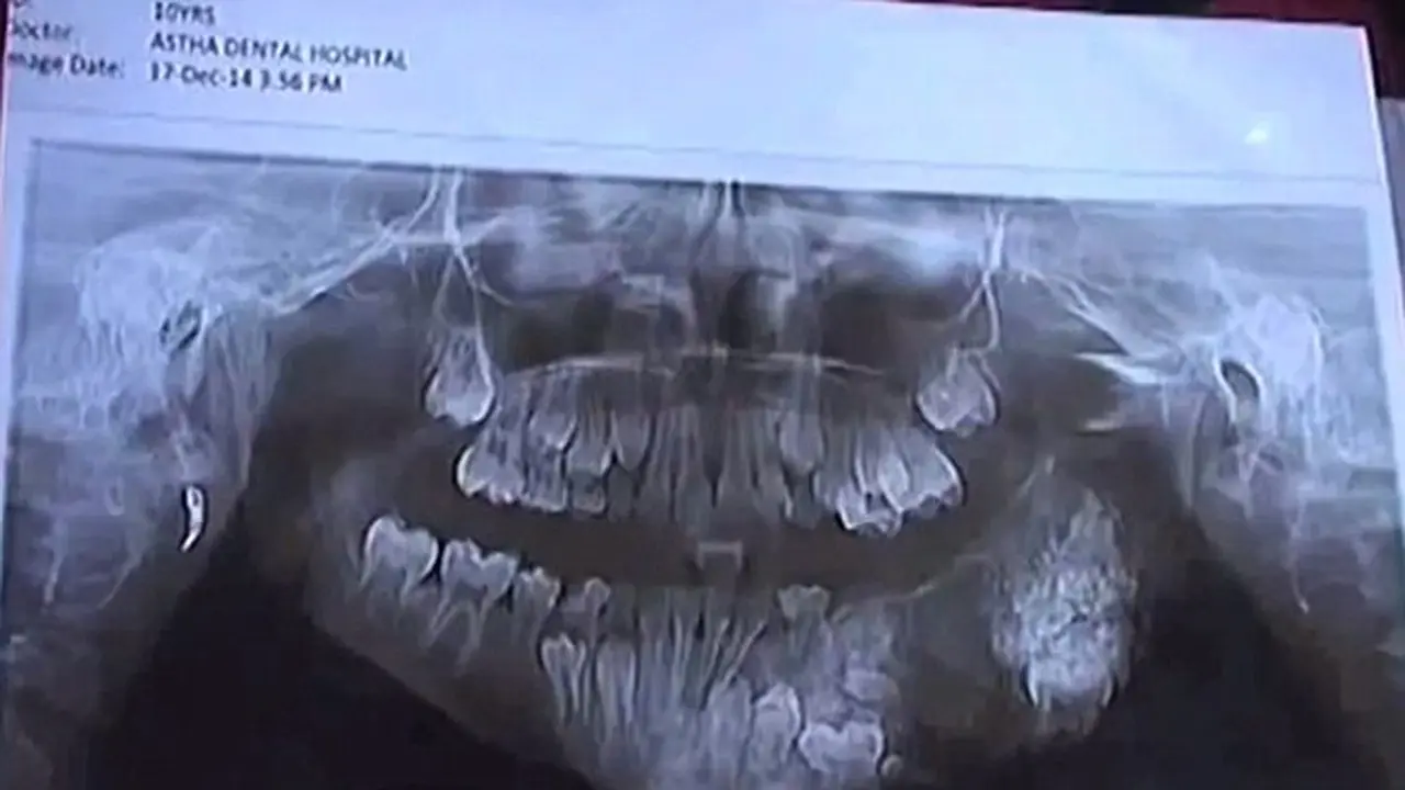 Tumor Langka, Bocah 7 Tahun Harus Cabut 80 Giginya