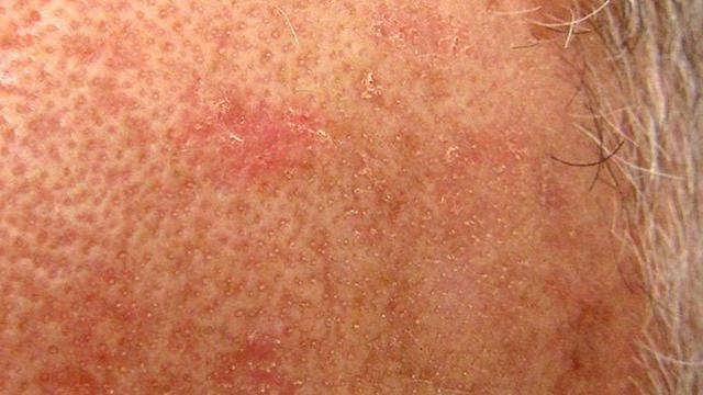 Actinic Keratosis