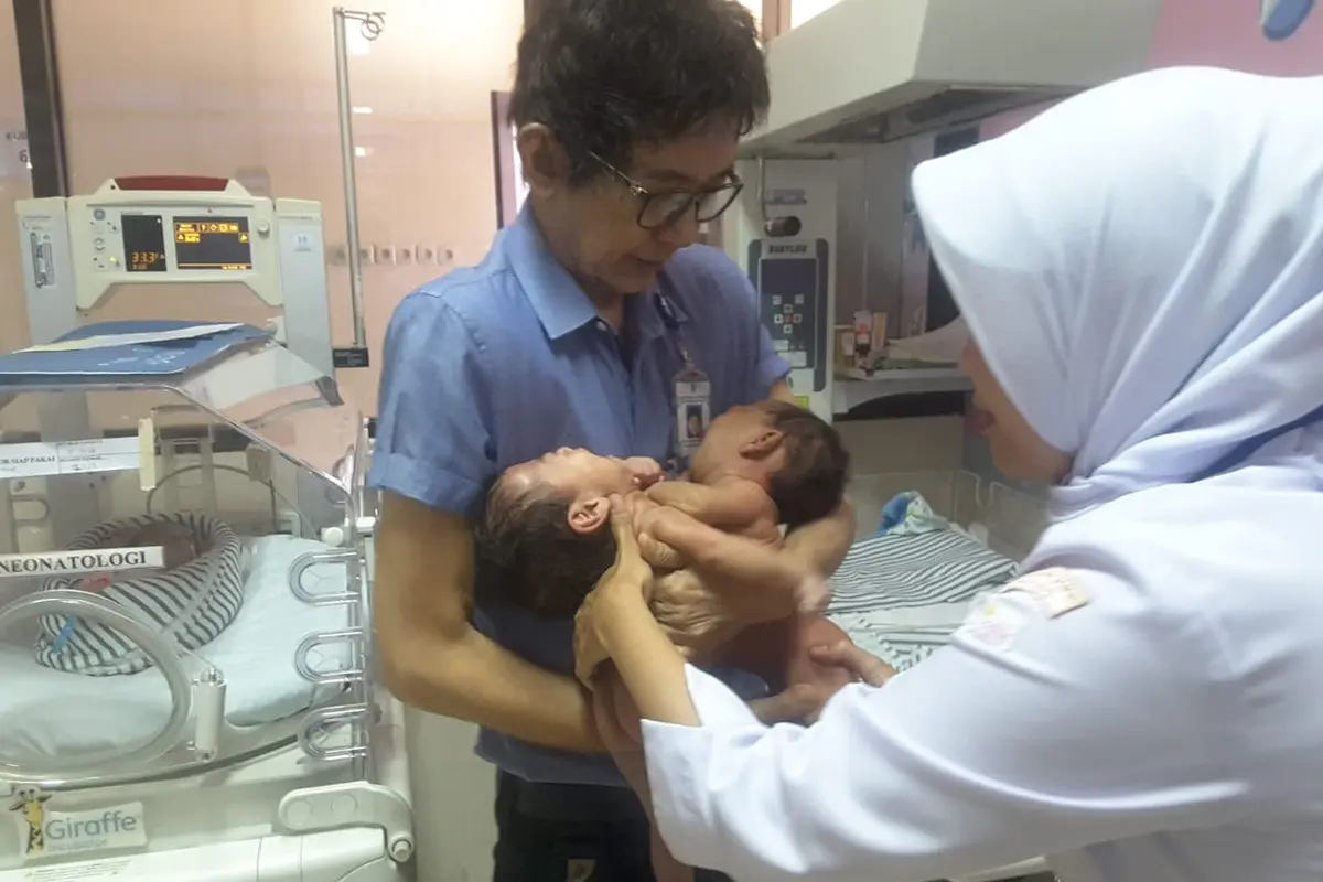 Bayi kembar siam