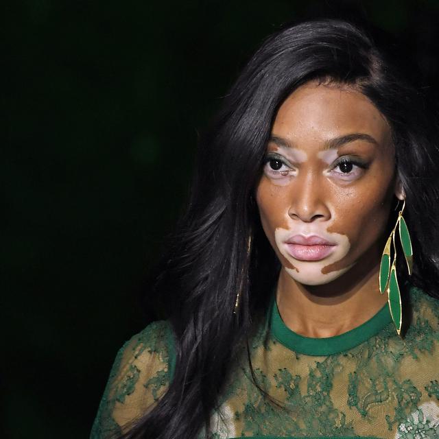 Apa Penyakit Kulit Vitiligo Bisa Disembuhkan Health Liputan6 Com
