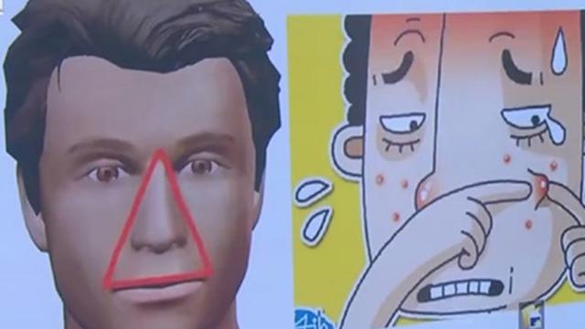 Ilustrasi jerawat. (Video Screen Grab)