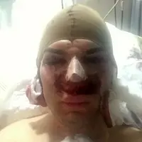 Operasi Plastik 42 Kali, Hidung Pria Mirip Ken Membusuk | via: indiatimes.com