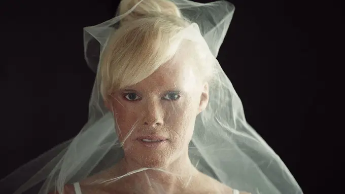 [Bintang] Dulu Dibully karena Kulitnya Bersisik, Sekarang Bikin Pangling