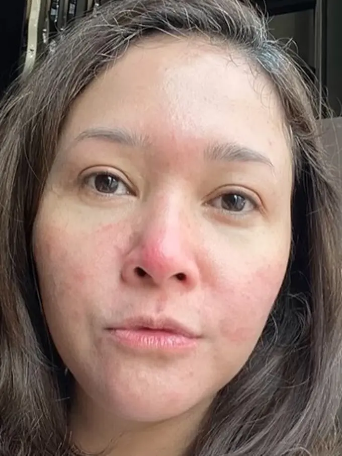 Maia Estianty derita rosacea (Instagram/maiaestiantyreal)