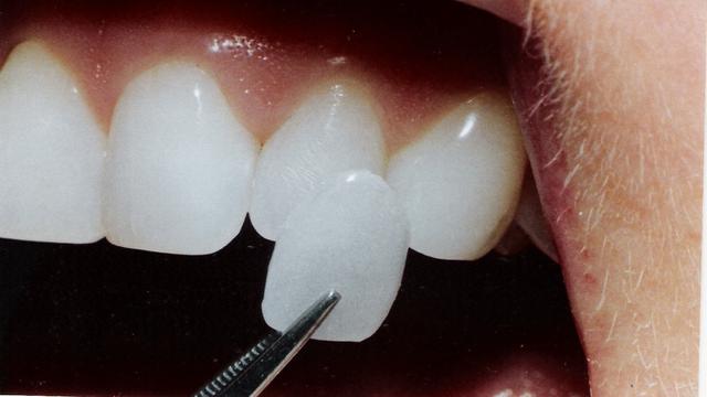 Kelemahan Veneer Gigi