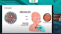 Wabah Campak di Sumenep, Mengenal Virus Penyebabnya yang Sangat Menular