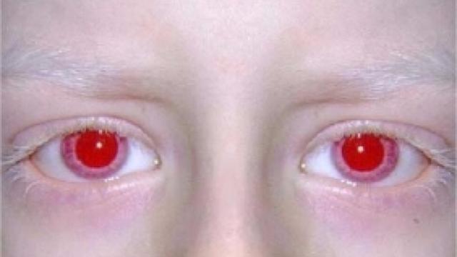 Gambar Mata Merah Pada Anak  Siti