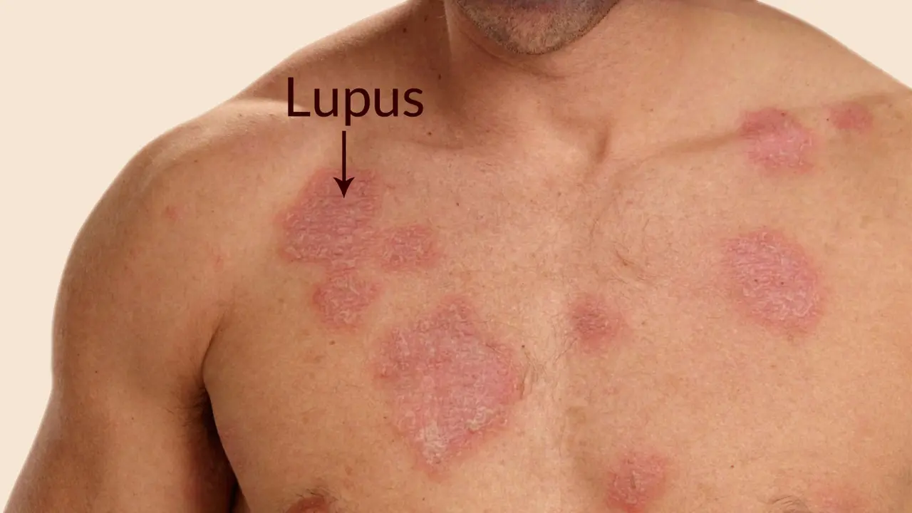 7 Fakta Tentang Penyakit Lupus yang Mungkin Belum Kamu Ketahui