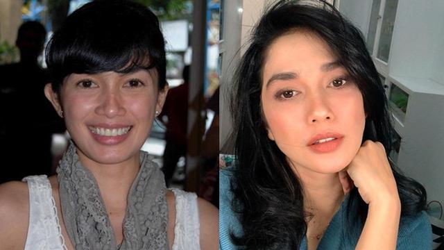 Potret Penyanyi Cantik Sebelum dan Sesudah Tanam Benang
