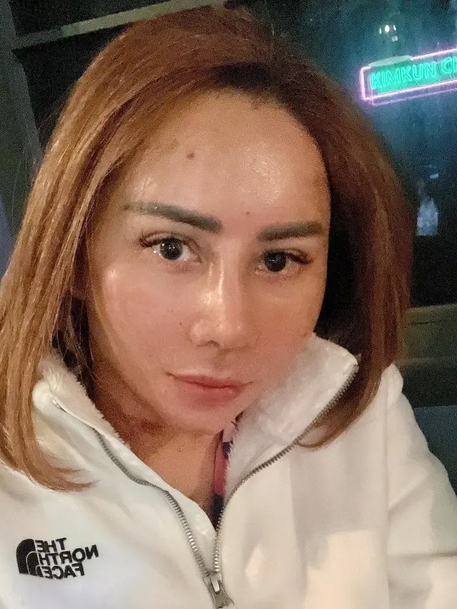 8 Potret Femmy Permatasari Pamer Wajah Usai Lakukan Operasi Plastik, Curi Perhatian