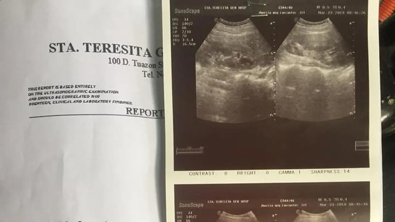 Tak Pernah Sarapan, Gadis Muda Kena Radang Dinding Lambung
