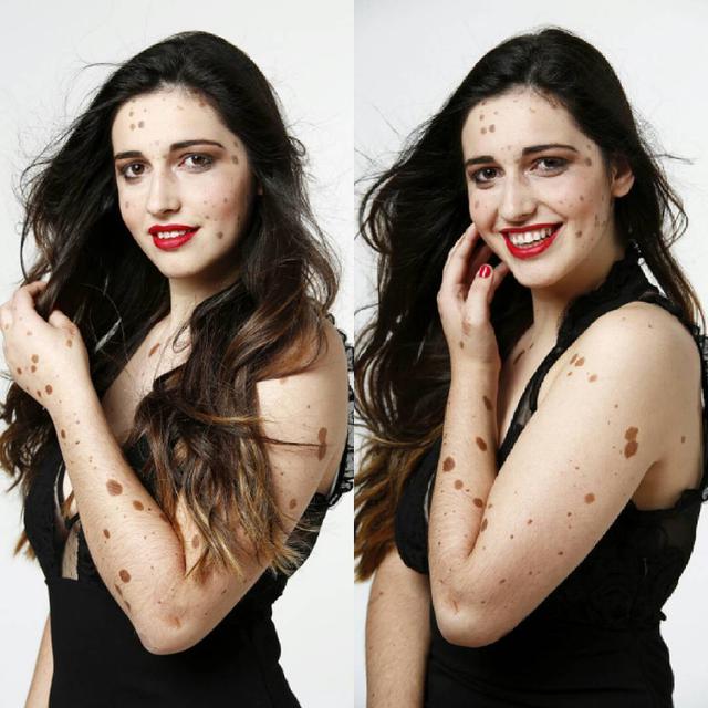 Alba Parejo, gadis yang punya 500 tanda lahir.