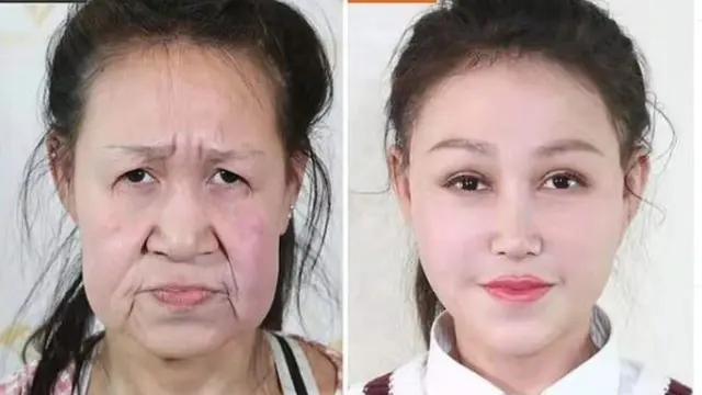 Gadis China Menjalani Operasi Plastik Karena Penyakit Langka