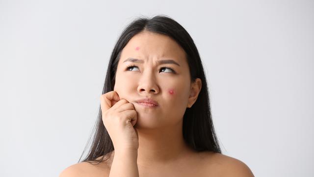 ilustrasi jerawat/shutterstock