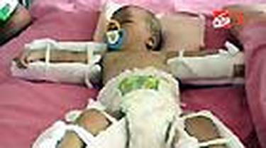 Bayi korban penganiayaan bernama Feri masih dirawat di RSUD Koja, Jakut. Walau relatif membaik, Feri harus menjalani perawatan lebih lanjut. 