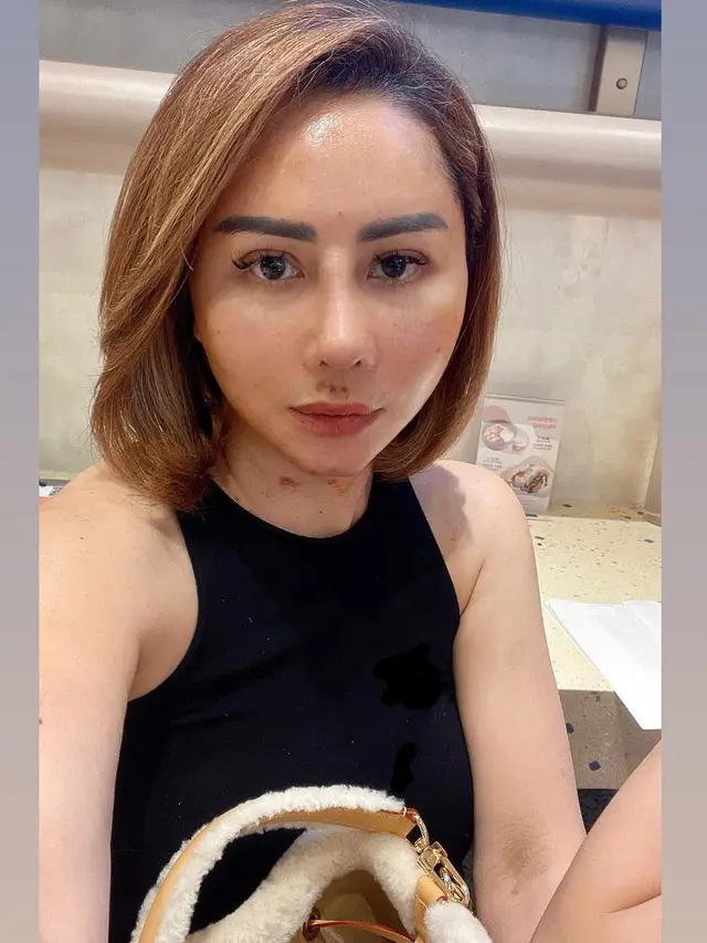 8 Potret Femmy Permatasari Pamer Wajah Usai Lakukan Operasi Plastik, Curi Perhatian