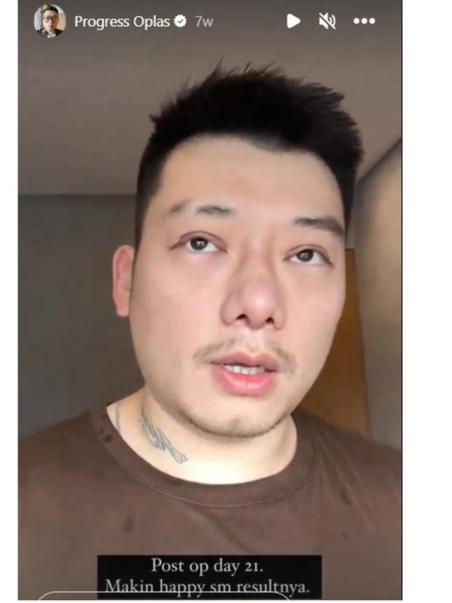 7 Potret Chef William Gozali Jalani Operasi Plastik, Perubahannya Bikin Pangling