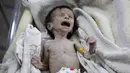 Sahar Dofdaa, bayi Suriah yang menderita kekurangan gizi parah di sebuah klinik pinggiran kota Damaskus, yang dikuasai oposisi, 21 Oktober 2017. Bayi itu hanya tersisa kulit karena sang ayah tidak mampu membeli makanan untuknya. (Amer ALMOHIBANY/AFP)
