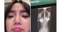 Fuji An Sedih Setelah Didiagnosis Skoliosis dan Mengetahui Tulang Belakang Miring. Skoliosis Adalah Kondisi Tulang Belakang Mengalami Kemiringan Sehingga Membentuk Huruf S atau C (instagram.com/fuji_an)