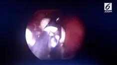 Selama operasi berlangsung, para dokter terkejut ketika menemukan  856 batu bersarang di saluran kencing  dan ginjal kiri seorang pria di India.